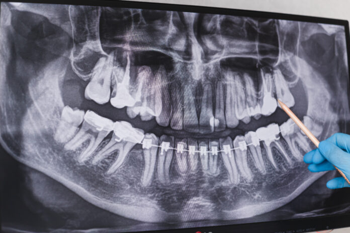 how-to-market-wisdom-teeth-surgery
